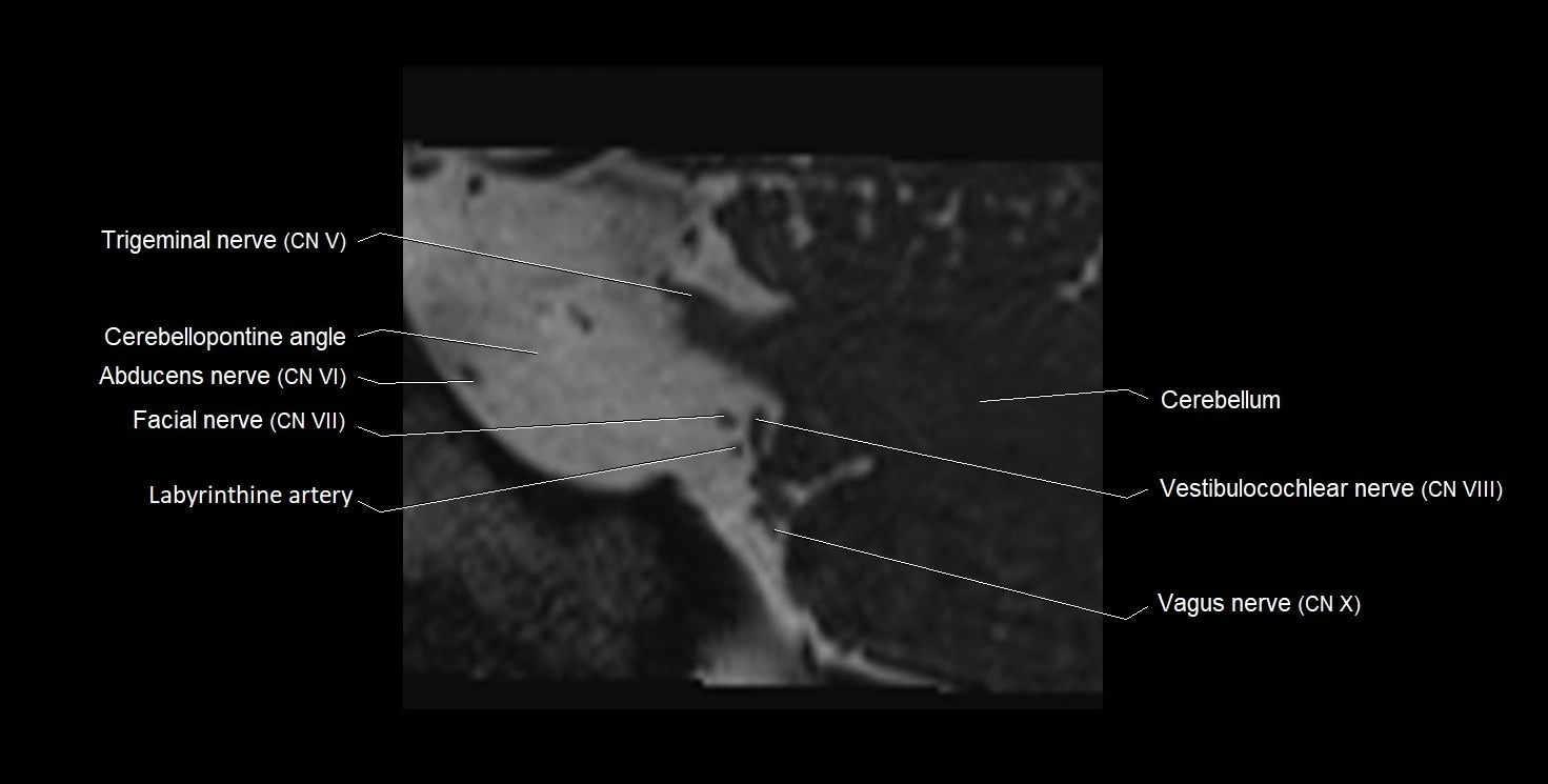 Internal auditory meatus (IAM) 3T sagittal cross sectional anatomy image 42.webp